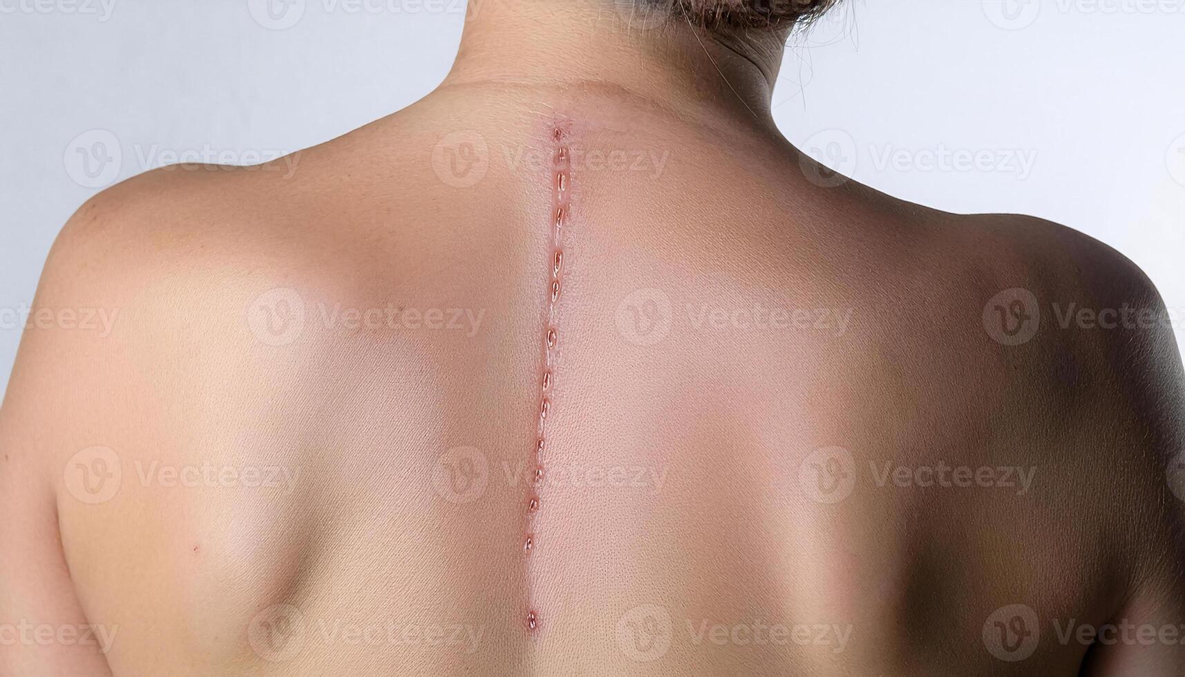 macro image of a vertical scar on the upper back caused by a surgery, showing detailed skin healing and precise stitching in isolated white background photo