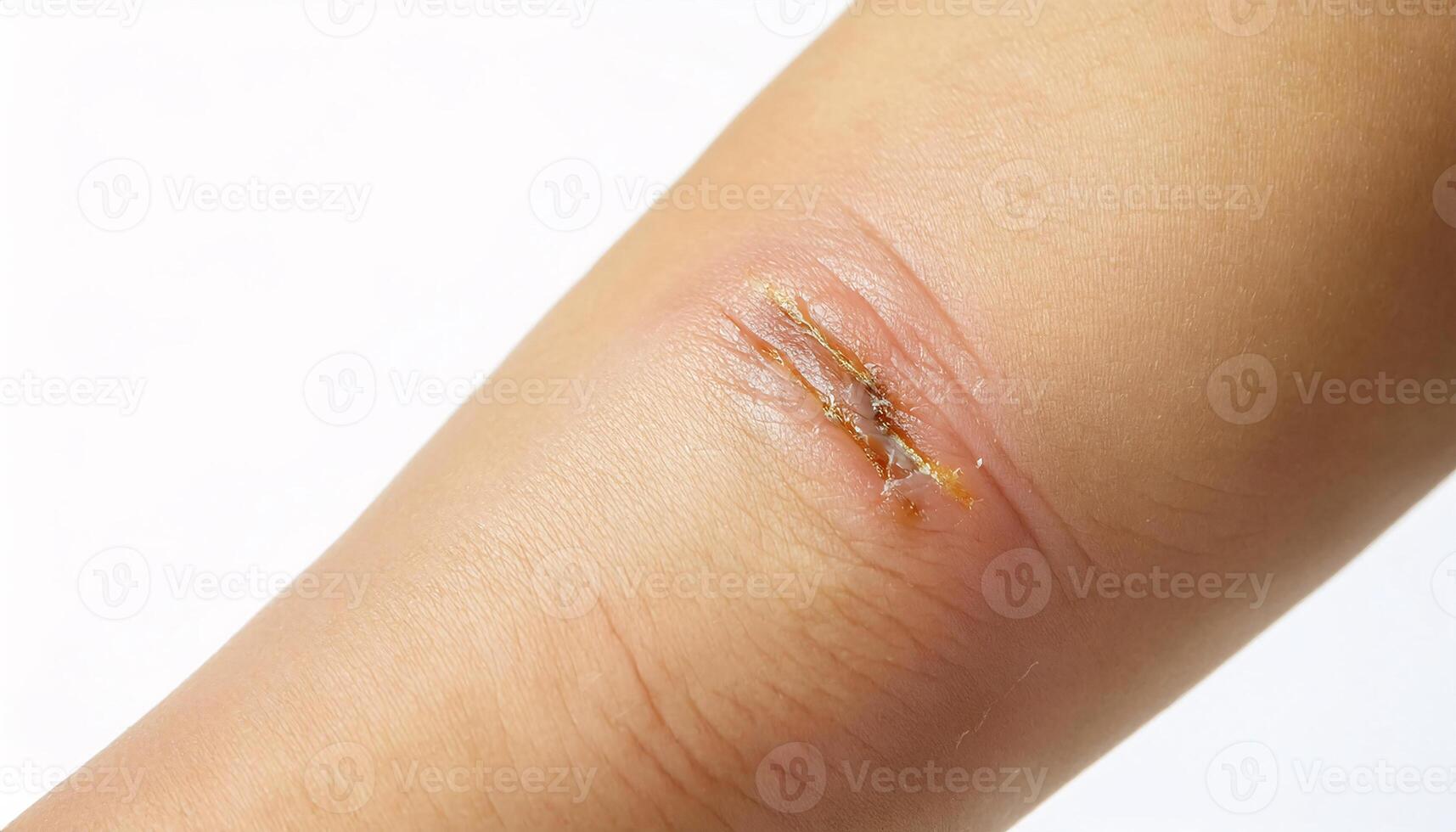 close-up of a scar on the arm caused by a fireworks accident, showcasing detailed healing process with uneven edges in isolated white background photo