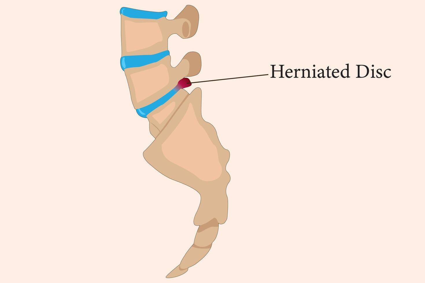 The image illustrates a herniated disc in the human spine with labeled detail. eps 10 vector