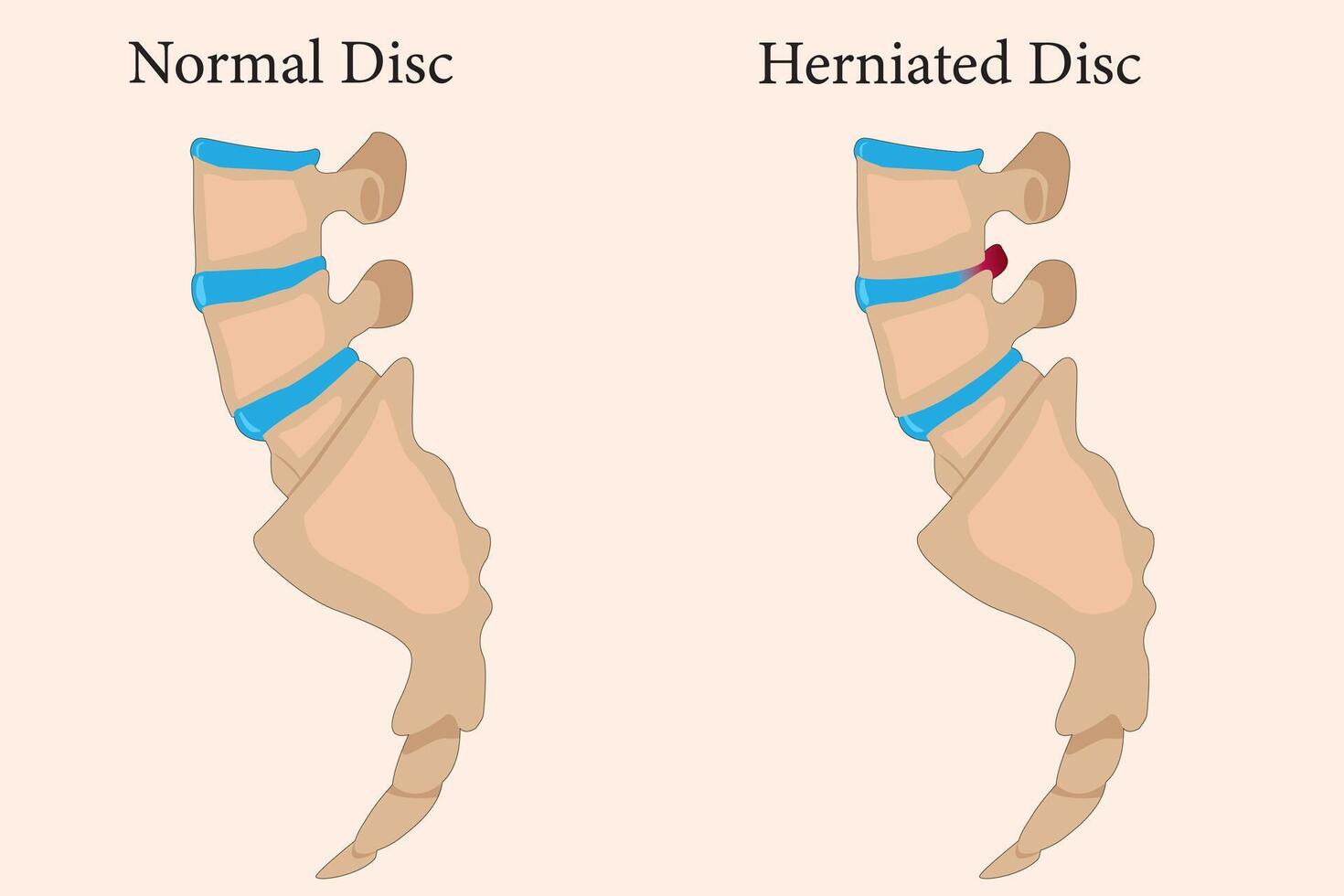 Comparing normal cervical disc and disc herniated of the patient. Illustration of Medical diagram about the problem on the spine makes pain or disability. eps 10 vector