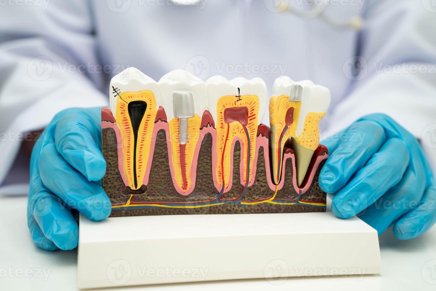 Dentist holding dental implant, artificial tooth roots into jaw, root canal of dental treatment, gum disease, teeth model for dentist. photo