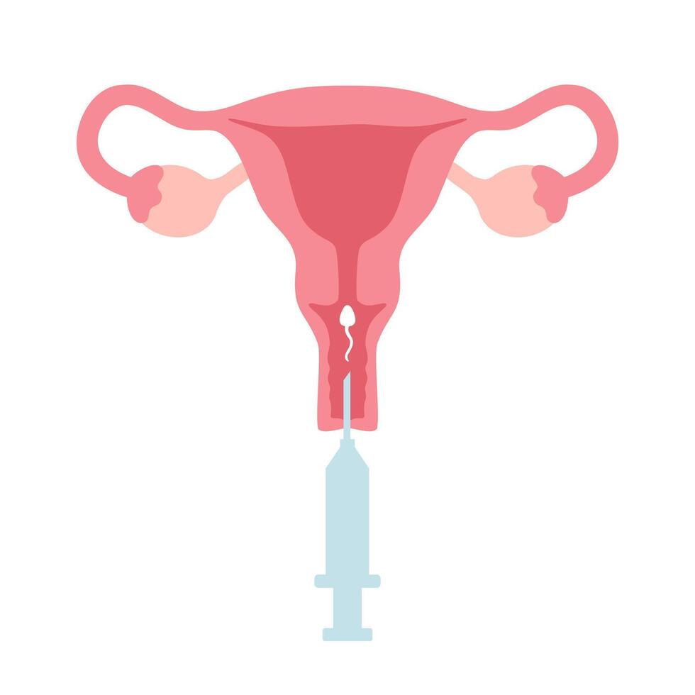 Intrauterine insemination infographic. IUI. Uterus and syringe with sperm illustration in cartoon flat style vector
