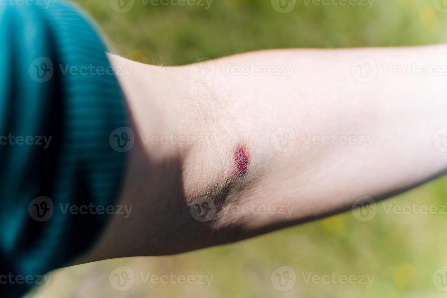 A closeup captures a healing arm injury on light skin in sunlight, symbolizing health and recovery. It highlights the bodys ability to recover from minor injuries photo