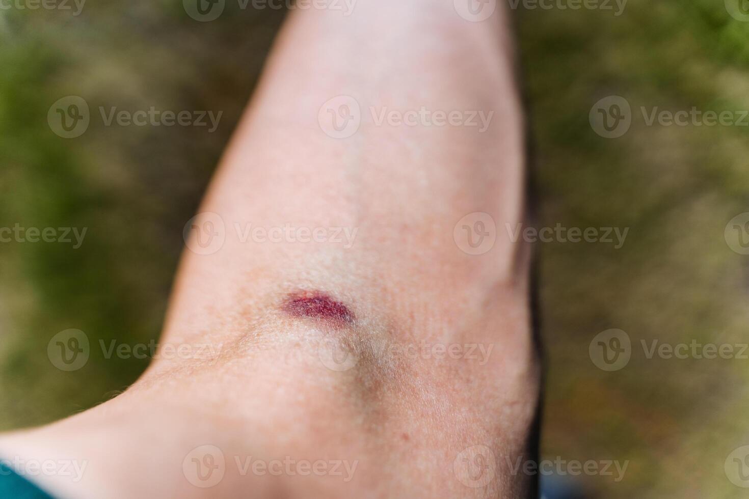 Documenting the gradual healing process of a bruise on the arm, this closeup highlights the different stages of injury recovery and the bodys natural response to trauma photo