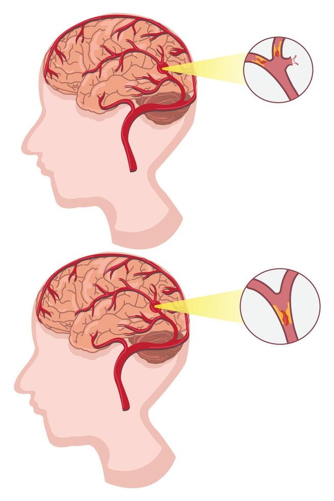 Comparison of ischemic and hemorrhagic stroke, highlighting affected brain blood vessels. eps 10 vector