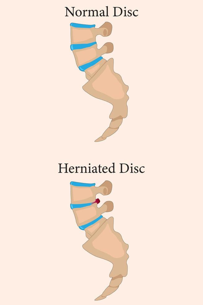 Comparison between normal and herniated spinal discs with clear visual differences. eps 10 vector