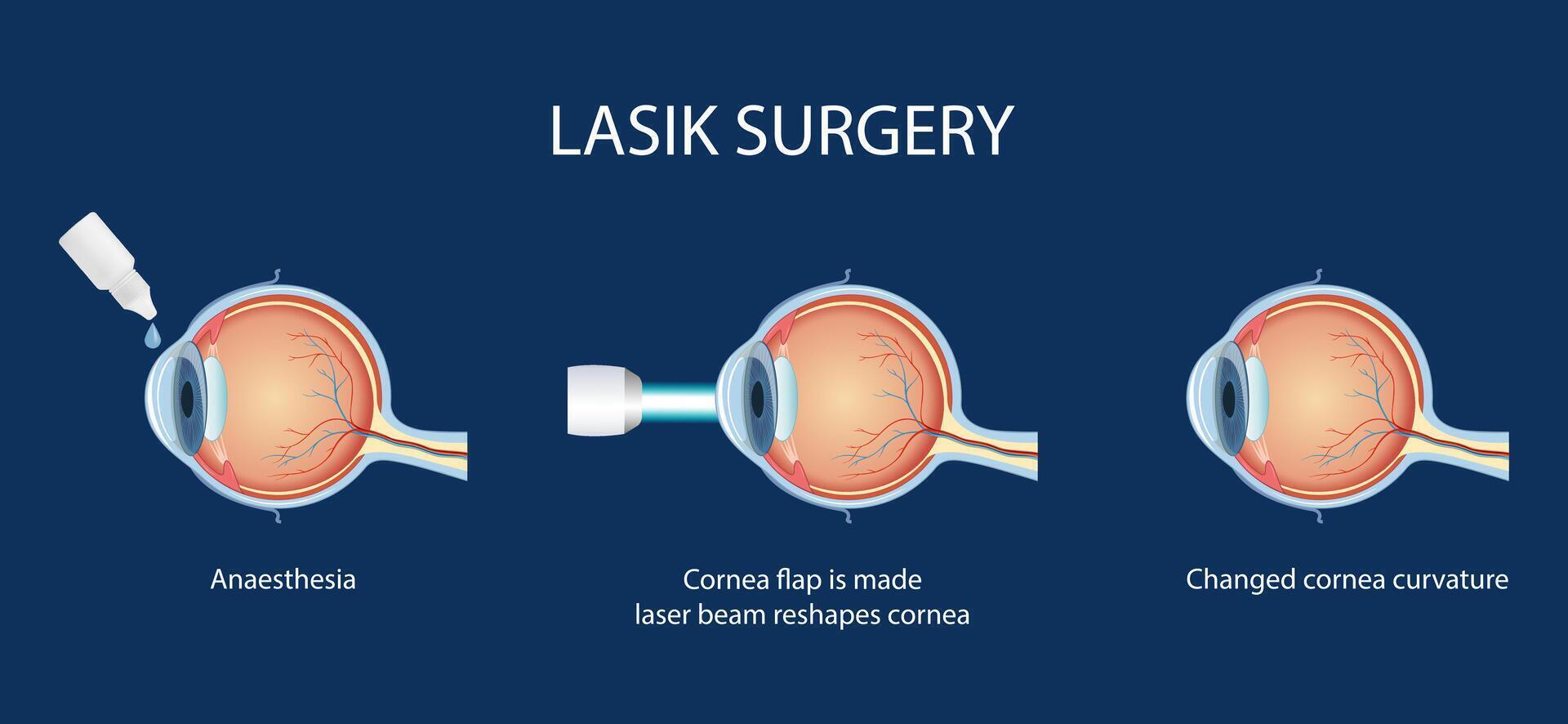 The process of laser eye surgery LASIK. Vision correction for nearsightedness, farsightedness, and astigmatism vector