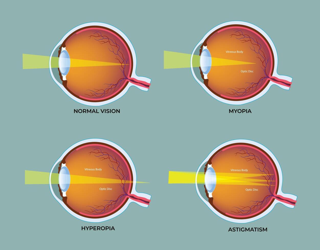 Illustration of most common eye disorders diagram vector