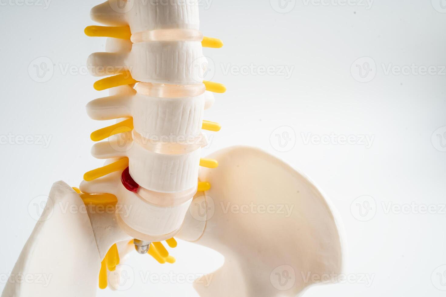 Lumbar spine displaced herniated disc fragment, spinal nerve and bone. Model for treatment medical in the orthopedic department. photo