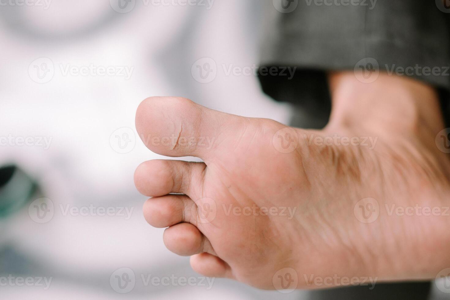 Close up of a cracked and dry skin on the sole of a big toe photo