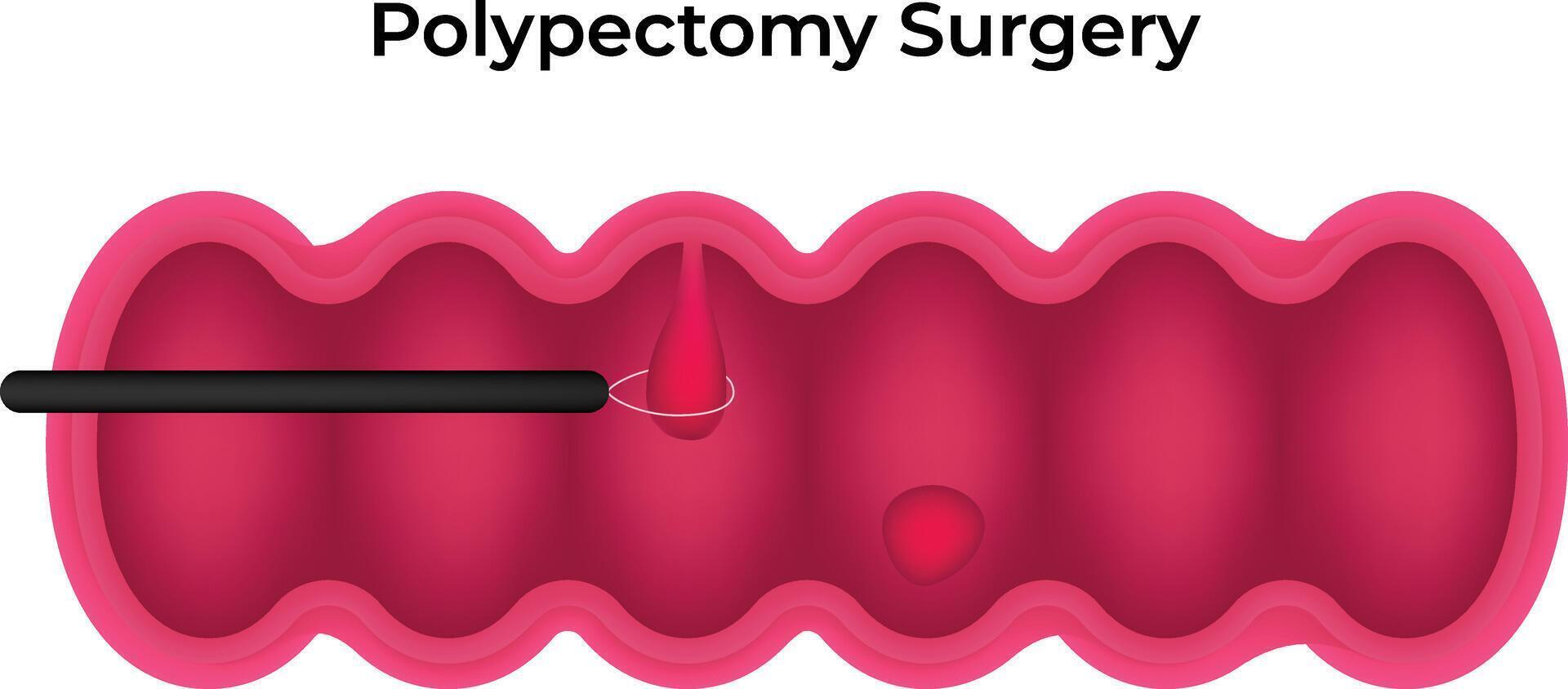 Polypectomy Surgery Science Design Illustration Diagram vector