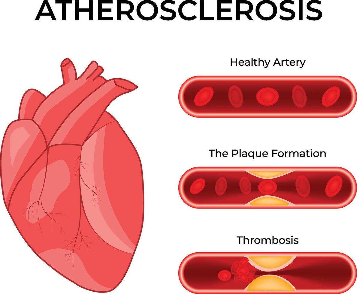 Atherosclerosis Science Design Illustration Diagram vector