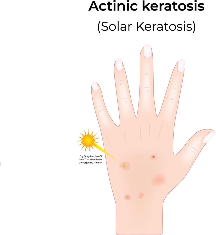 Actinic Keratosis Science Design Illustration Diagram vector