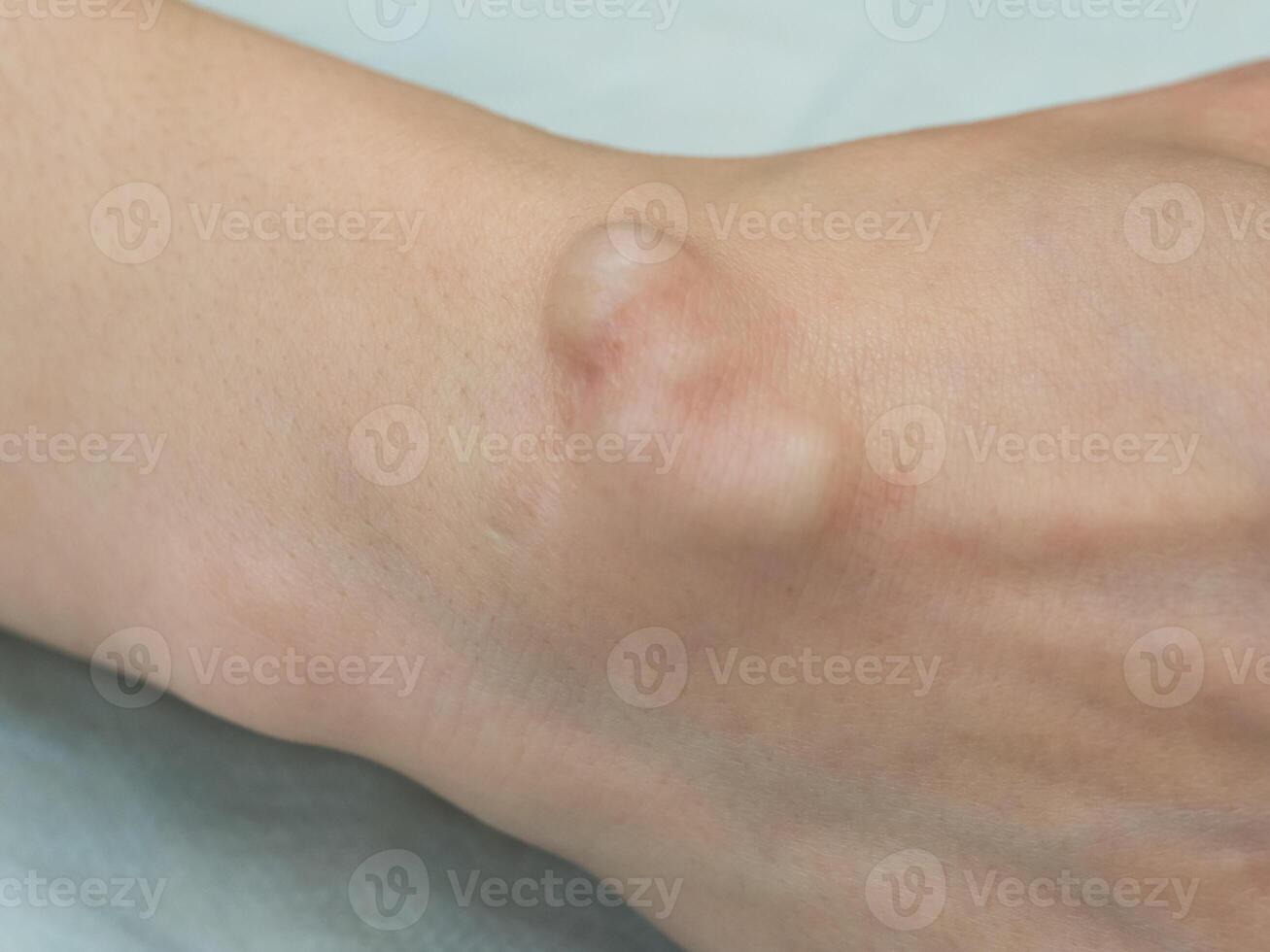 Big cyst hygroma, fluid filled lump associated with a joint, a tumor or swelling on top of a joint. photo