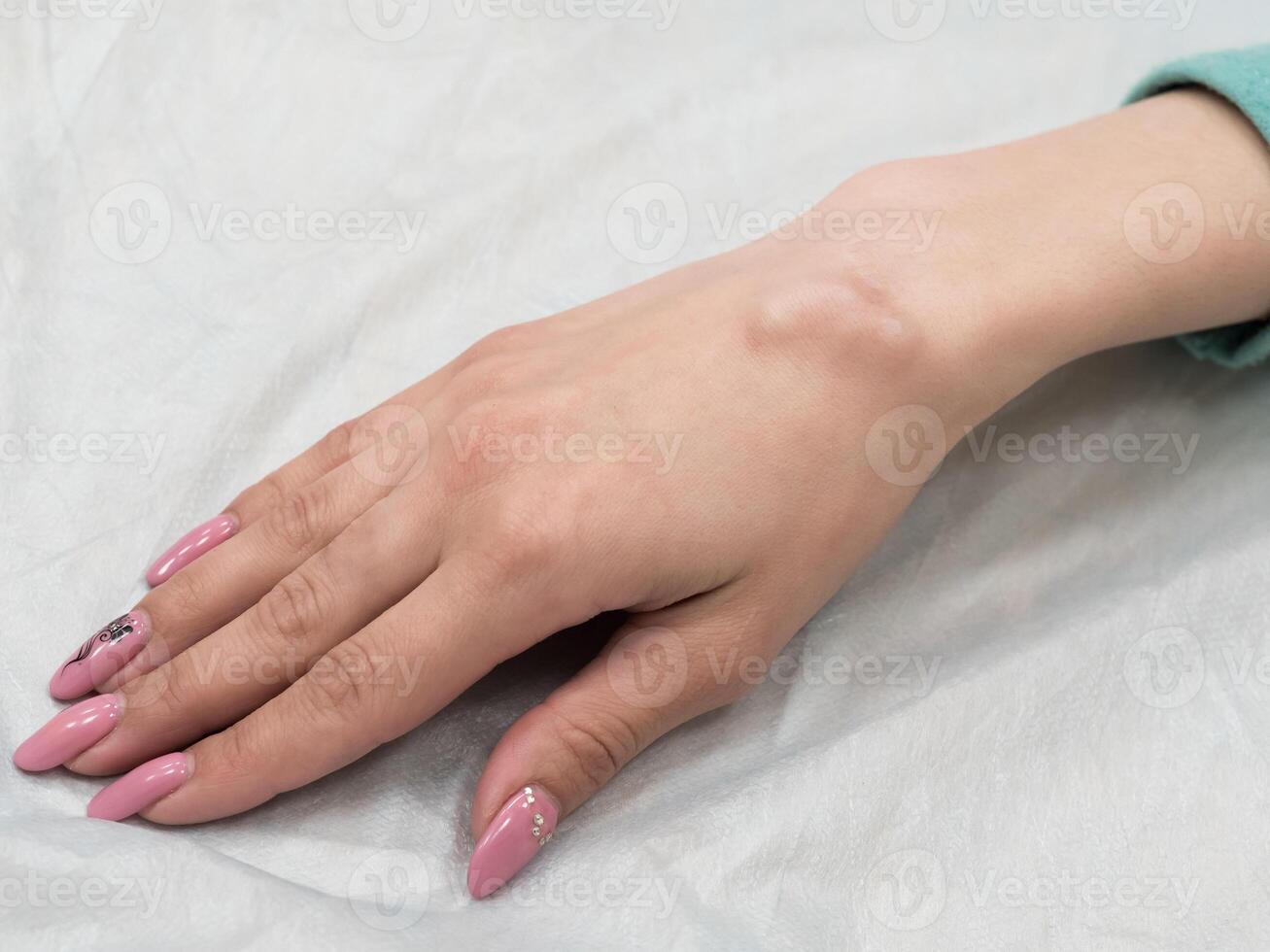 Big cyst hygroma, fluid filled lump associated with a joint photo