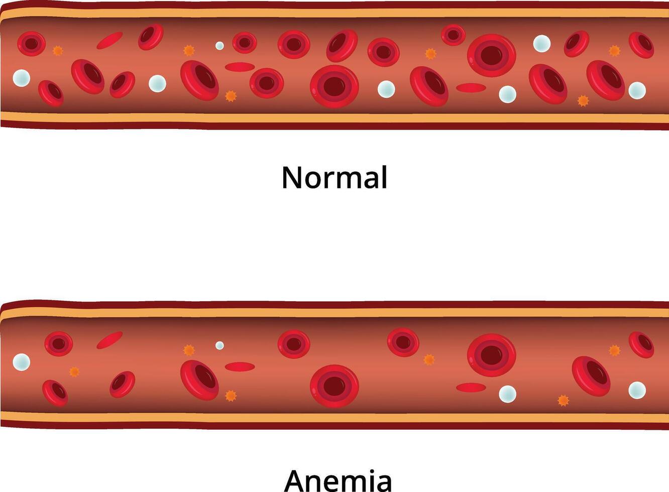Normal Anemia Design Illustration vector