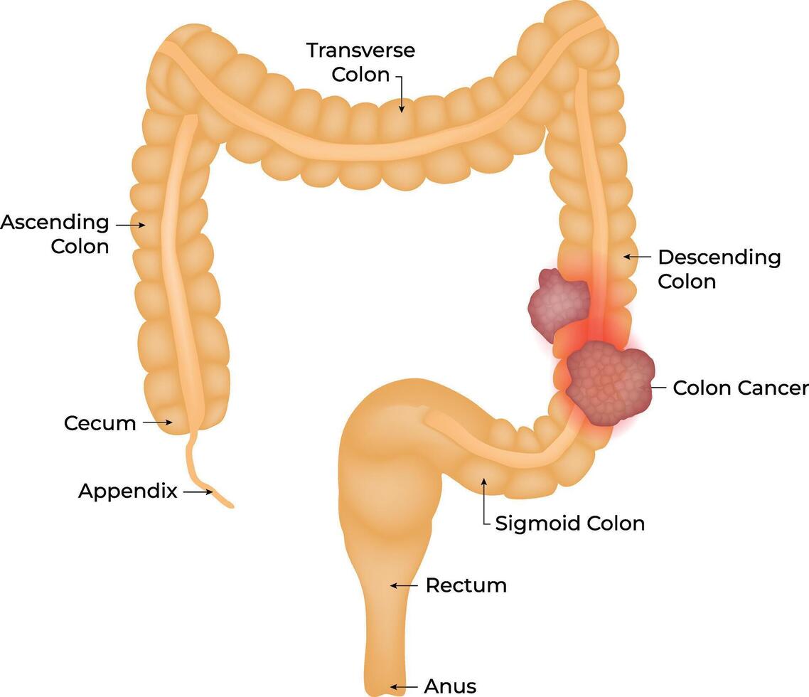 Appendectomy Appendicitis Anatomy Design Illustration vector