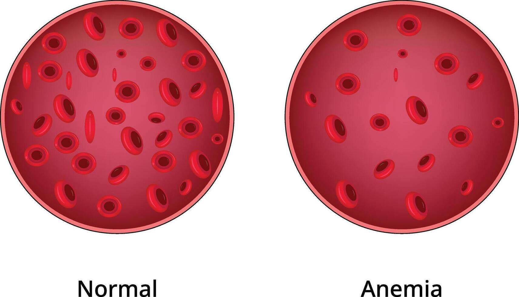 Normal Anemia Colorful Design Illustration vector