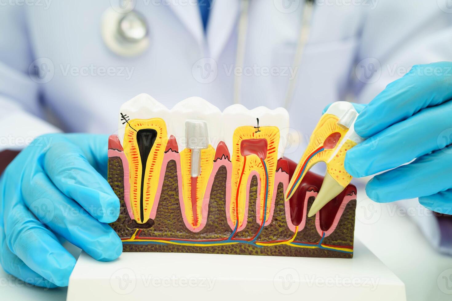 Dentist holding dental implant, artificial tooth roots into jaw, root canal of dental treatment, gum disease, teeth model photo
