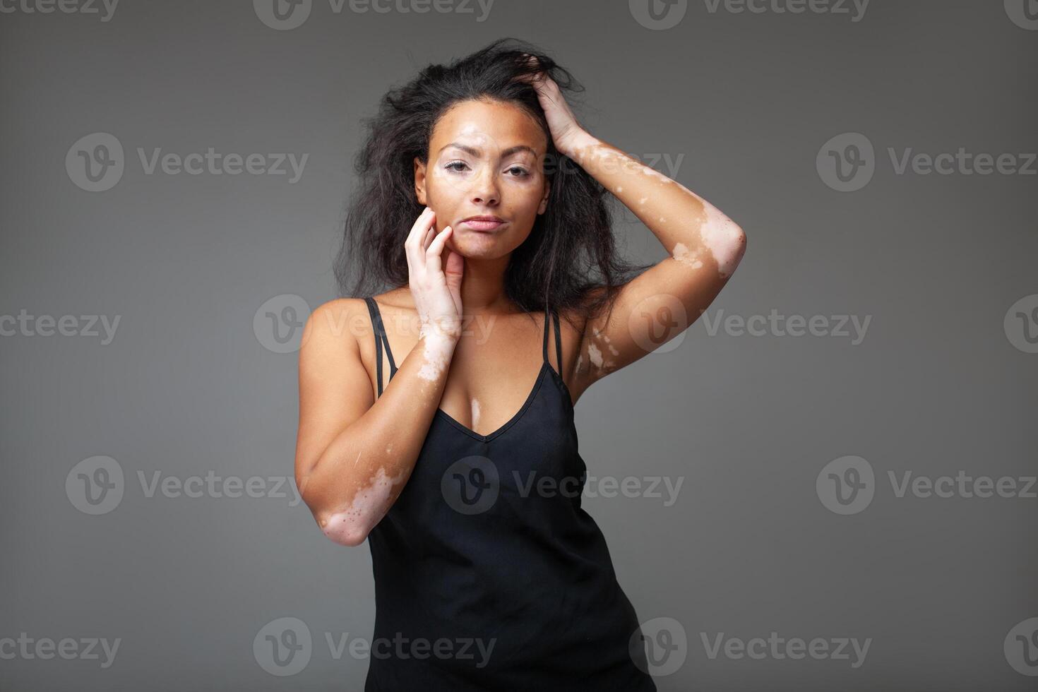 Confident fashion model with vitiligo with hand in hair in studio photo