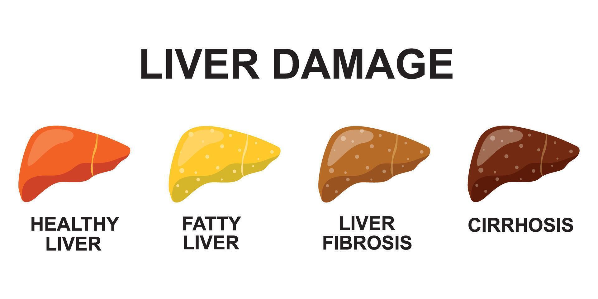 Stages of nonalcoholic liver damage. Healthy, fatty, fibrosis, cirrhosis. Liver Disease. Isolated illustration in flat style on white background vector