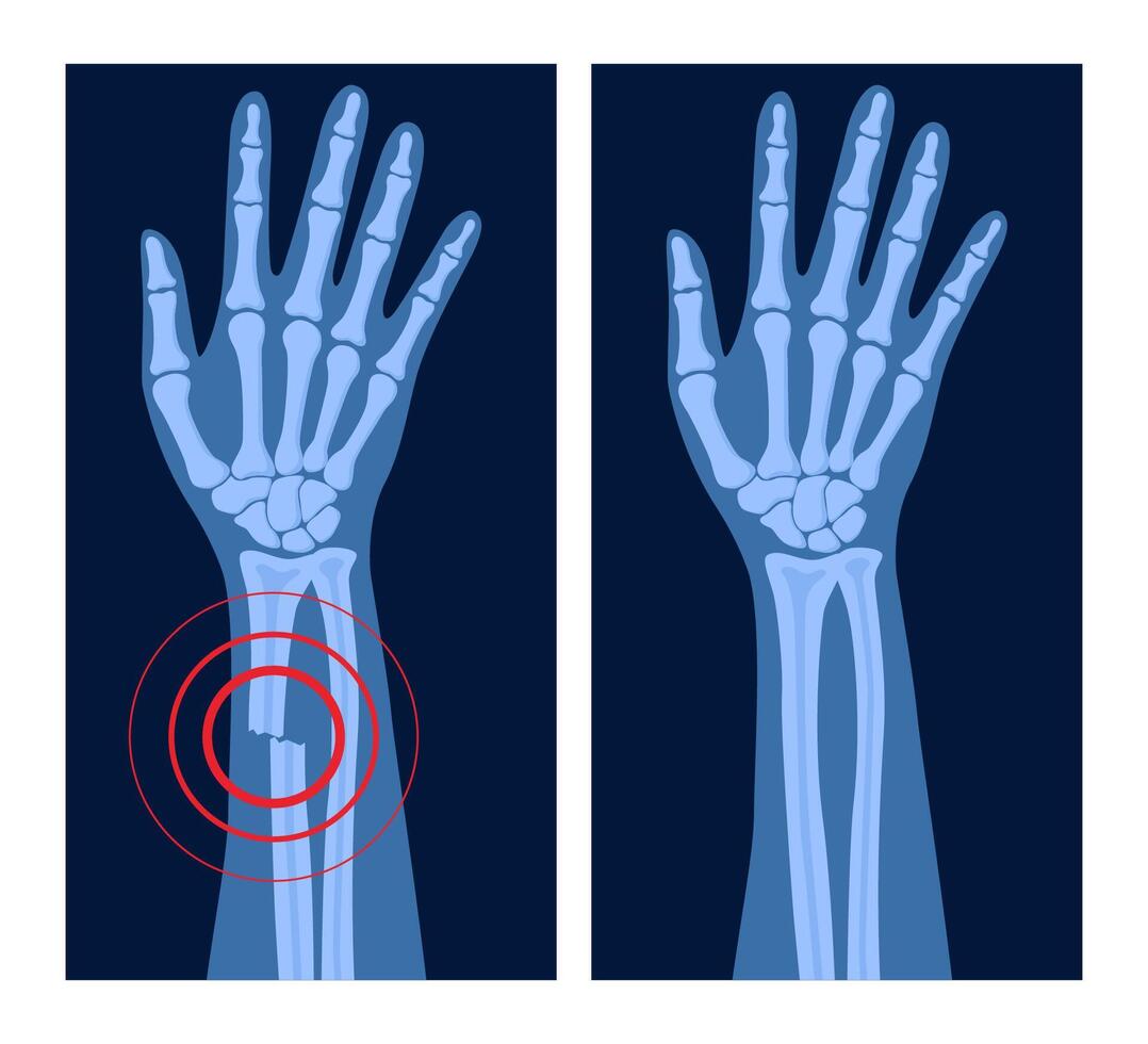 X ray of arm fracture with pain point. Broken hand with open type of fracture. Human skeleton anatomy concept. Medical banner for clinic or hospital. illustration vector