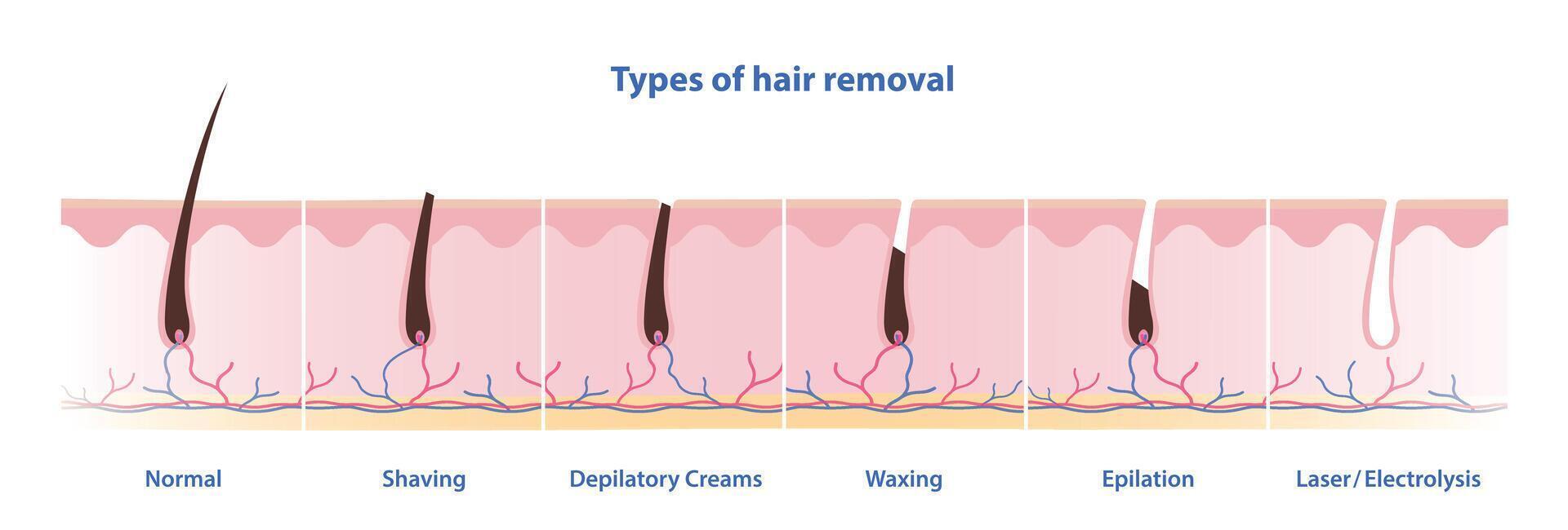 Types of hair removal illustration on white background. Methods of remove unwanted hair include shaving, depilatory creams, waxing, epilation, laser and electrolysis. Skin care, beauty concept. vector