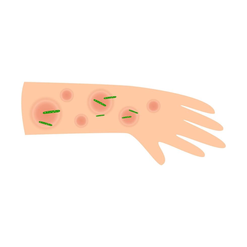hand leprosy disease. mycobacterium leprae infection concept vector