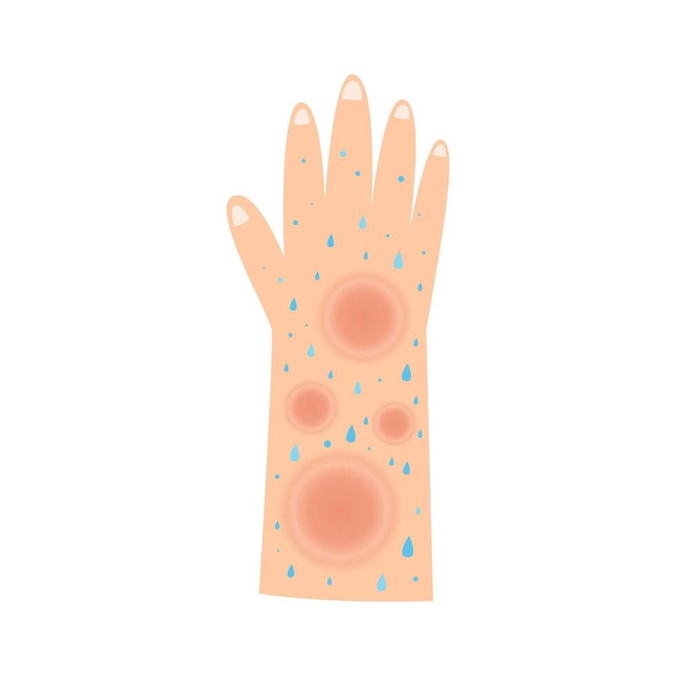 sweat leprosy disease. mycobacterium leprae infection concept vector