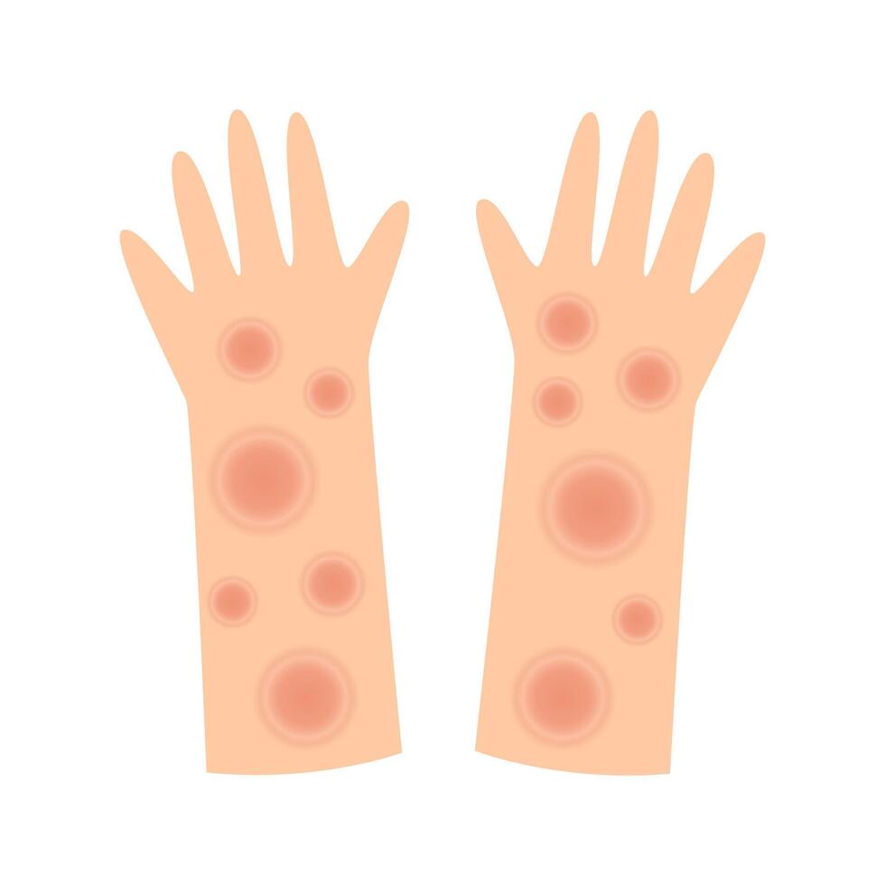 hands leprosy disease. mycobacterium leprae infection concept vector