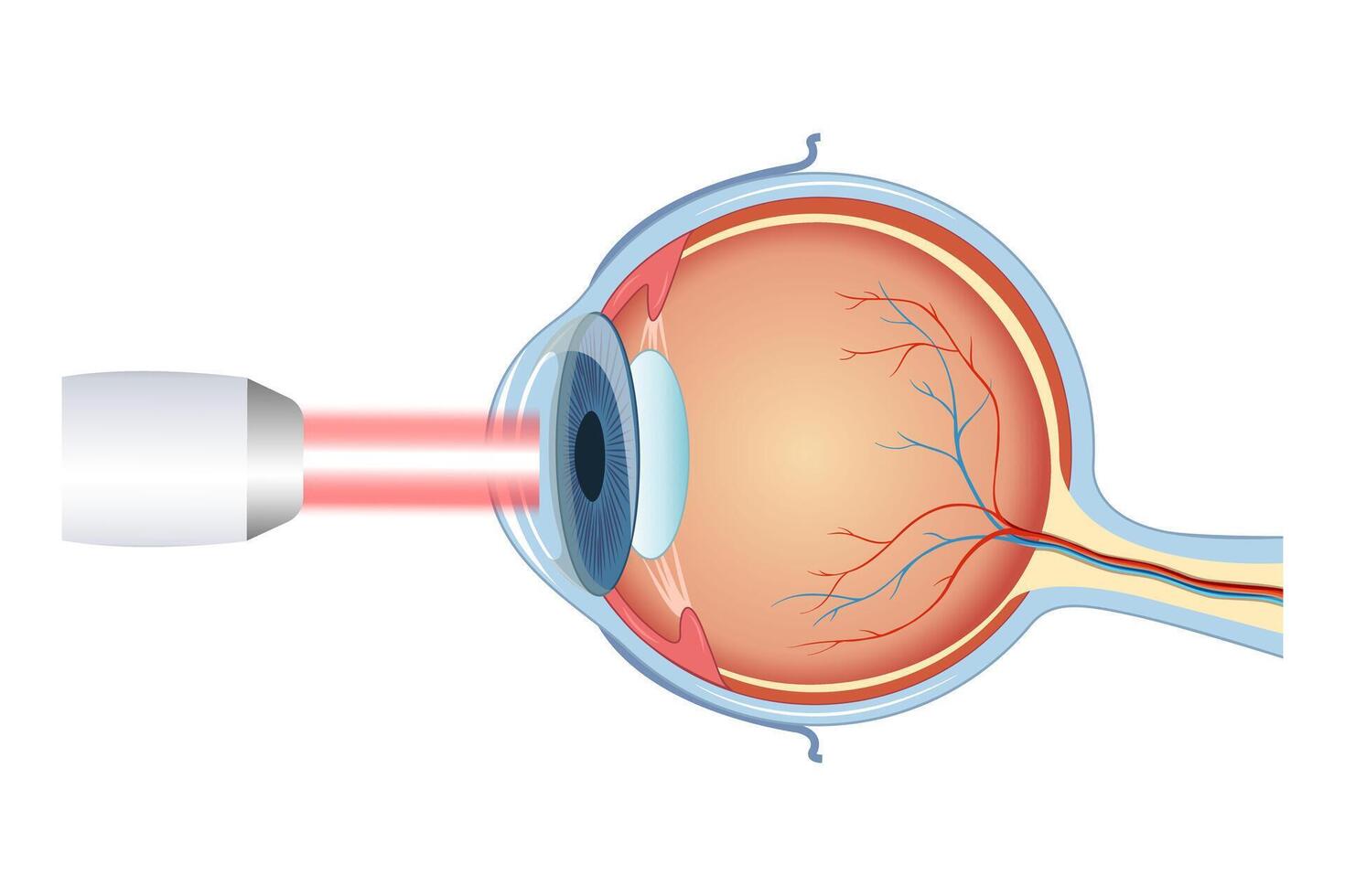 The process of laser eye surgery LASIK. Vision correction for nearsightedness, farsightedness, vector