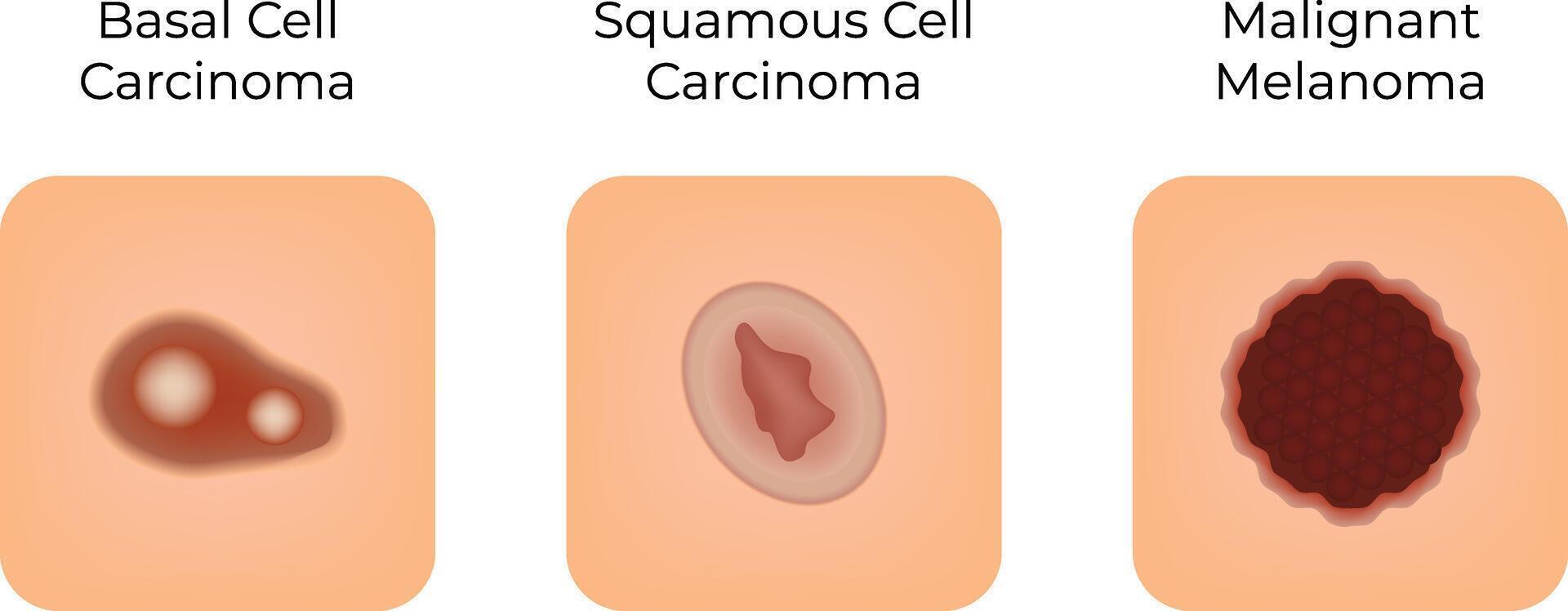 Basal Cell Squamous Cell Malignant Science Design Illustration Diagram vector