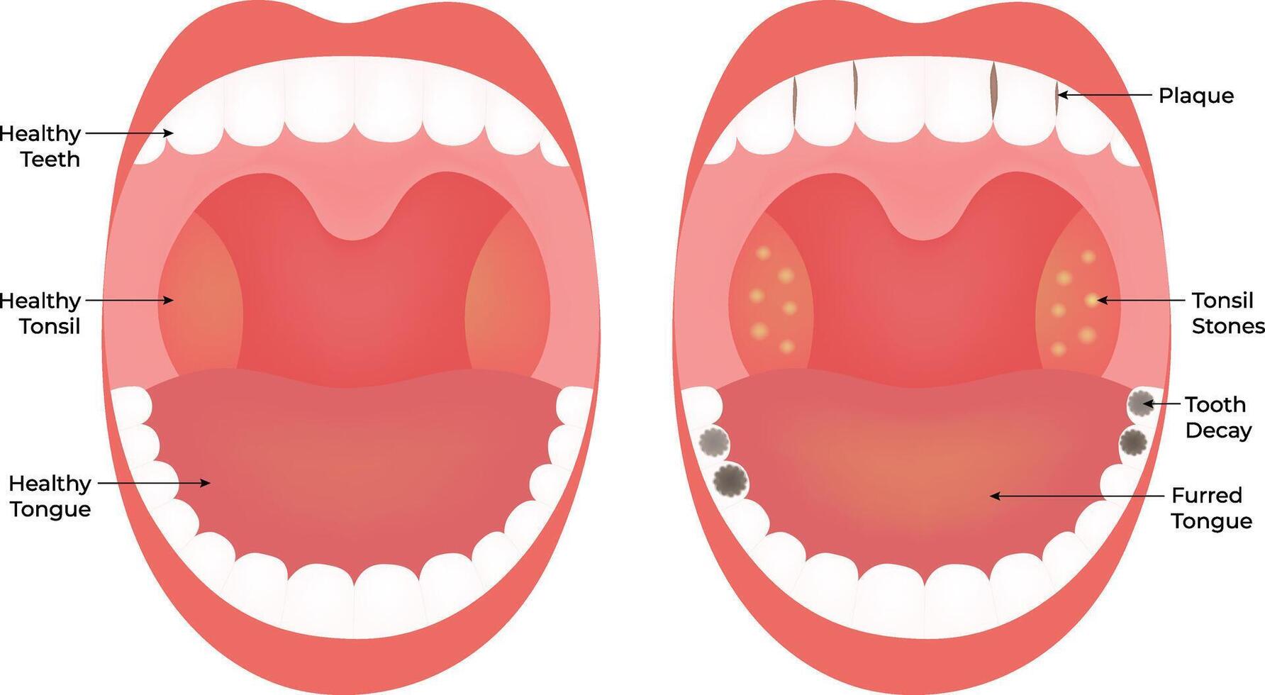 Healthy Teeth Tooth Deacy Science Desig Illustration Diagram vector