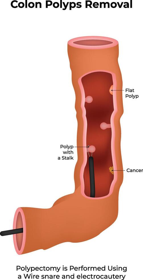 Colon Potyps Removal Science Design Illustration DDiagram vector