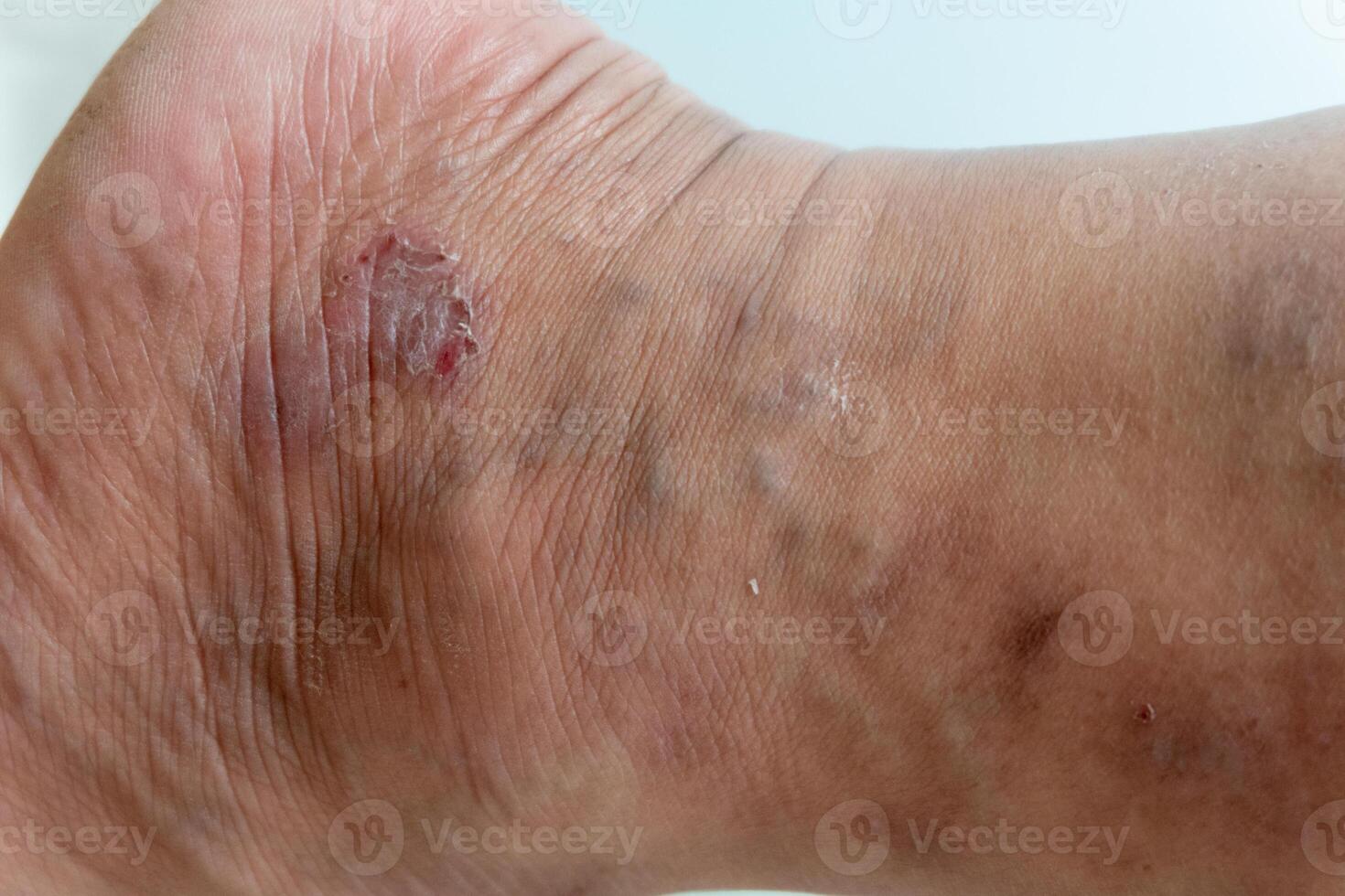 Skin disease of scabies infection by mites called Sarcoptes scabiei burrowing into leg skin. photo