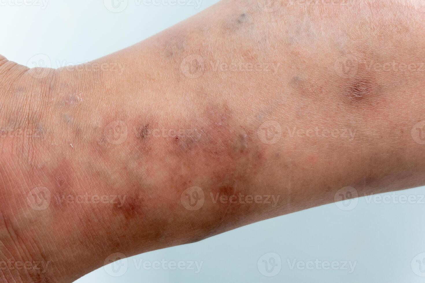 Skin disease of scabies infection by mites called Sarcoptes scabiei burrowing into the skin, pockmarked skin from leg skin. photo