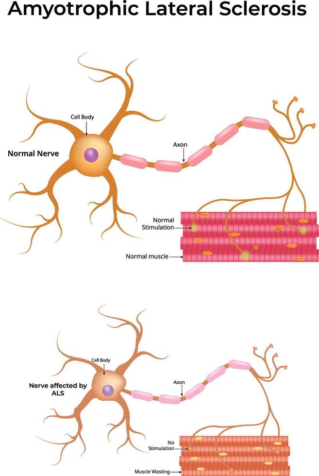 Amyotrophic Lateral Sclerosis Design Science Illustration vector