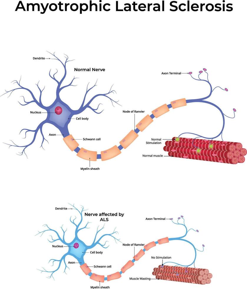 Amyotrophic Lateral Sclerosis Colorful Illustration vector