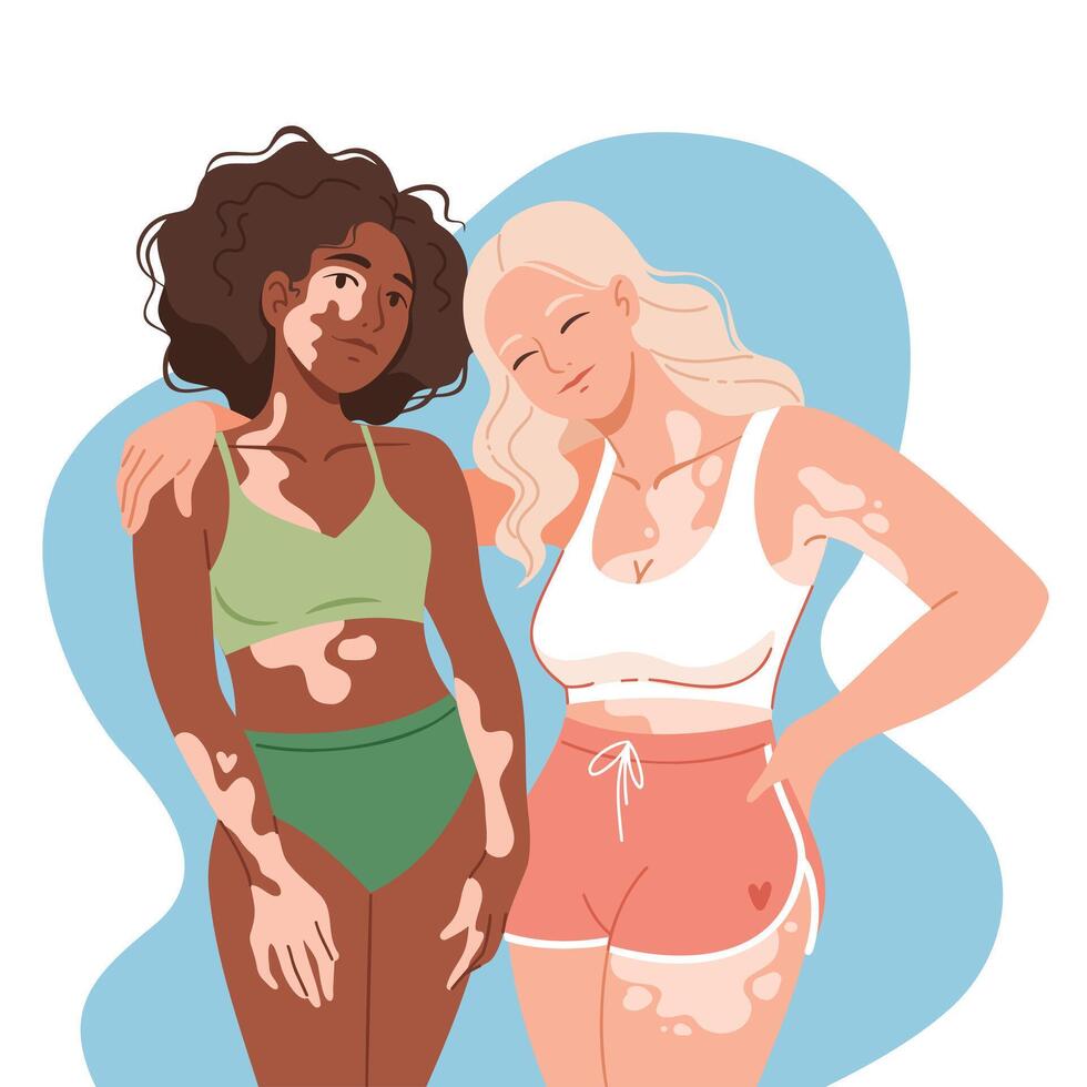 Beautiful dark-skinned and white-skinned women with vitiligo disease. Beauty of women with vitiligo, variety of appearance. Body positivity concept. People with vitiligo syndrome. vector