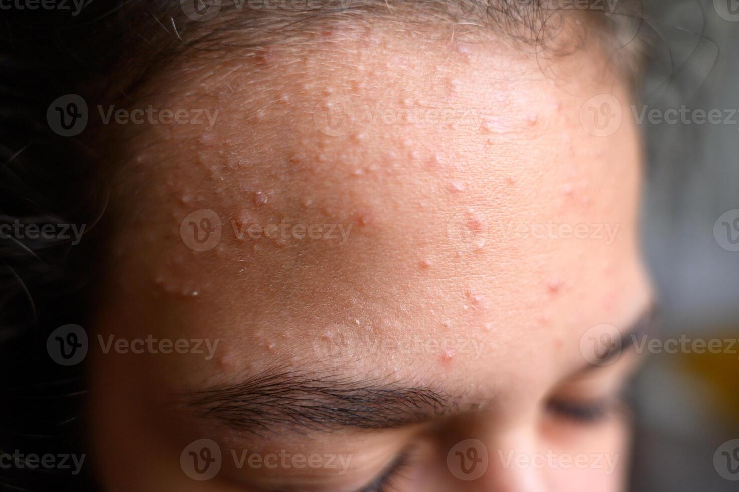 A teenage girl's forehead with akne blemishes photo