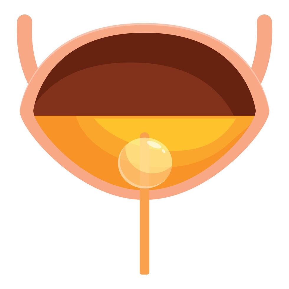 Urinary bladder storing urine with prostate gland showing benign prostatic hyperplasia vector