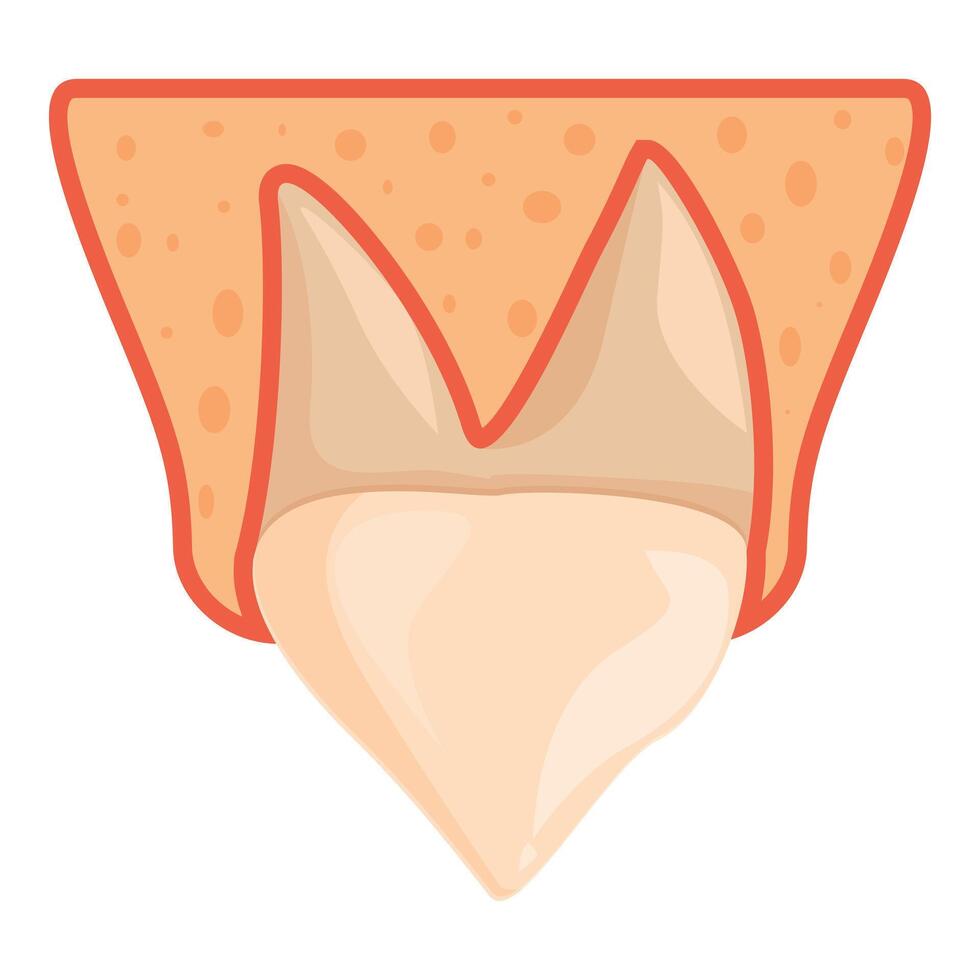 Impacted wisdom tooth under gum line, showing stage of eruption vector