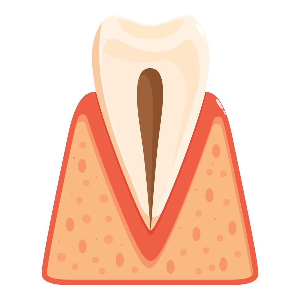 Tooth decay showing affected dentin and pulp illustrating gingivitis vector
