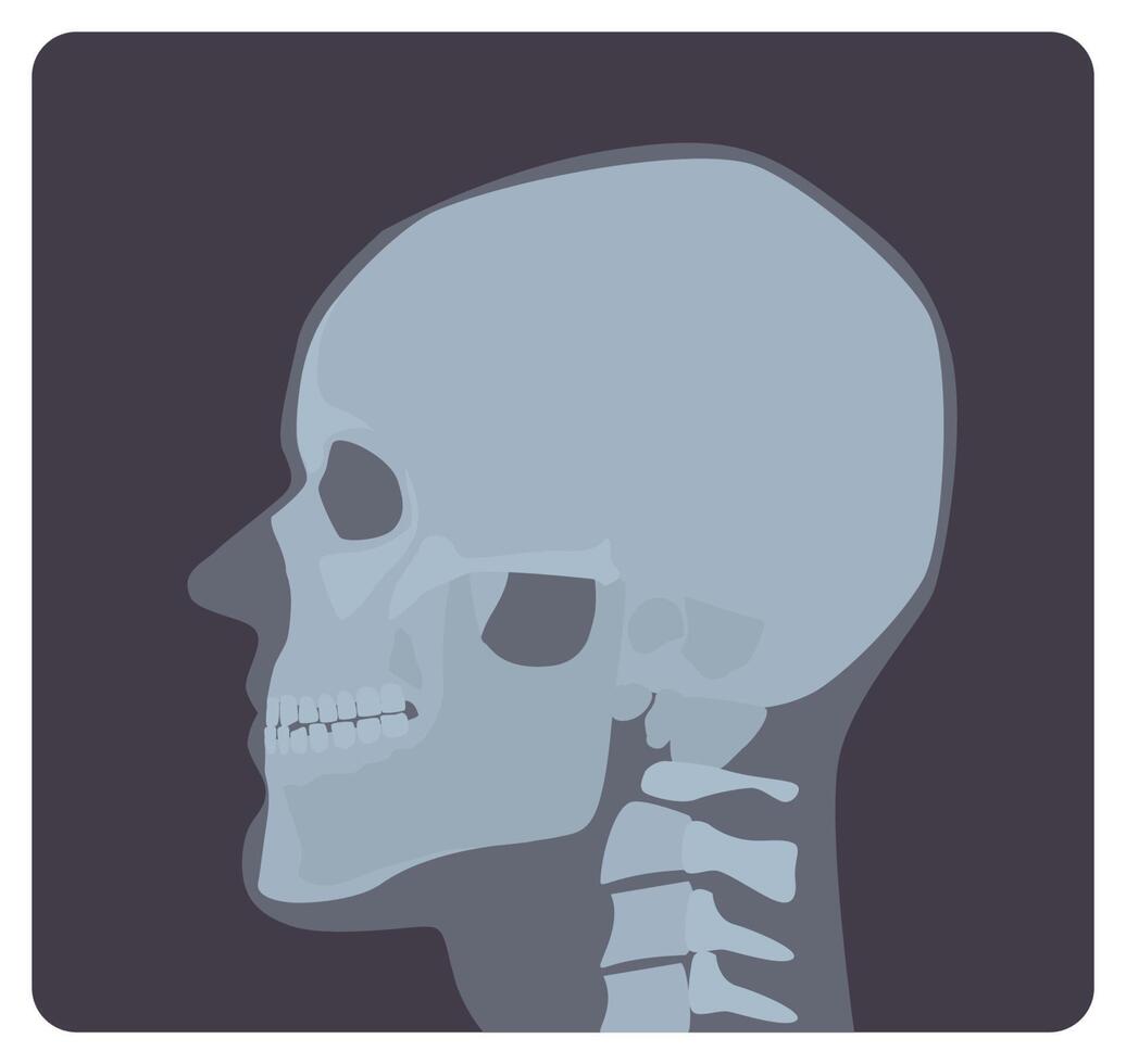 Lateral radiograph of skull. X-ray picture or radiographic image of head, side view. Modern medical radiography and human skeletal system. Monochrome illustration in flat cartoon style. vector