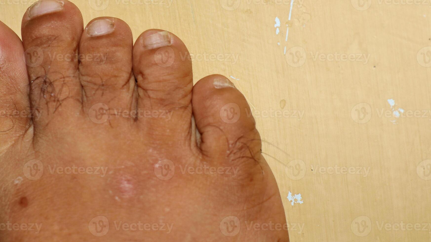 Close up of male foot and dirty long toe nail, barefoot photo