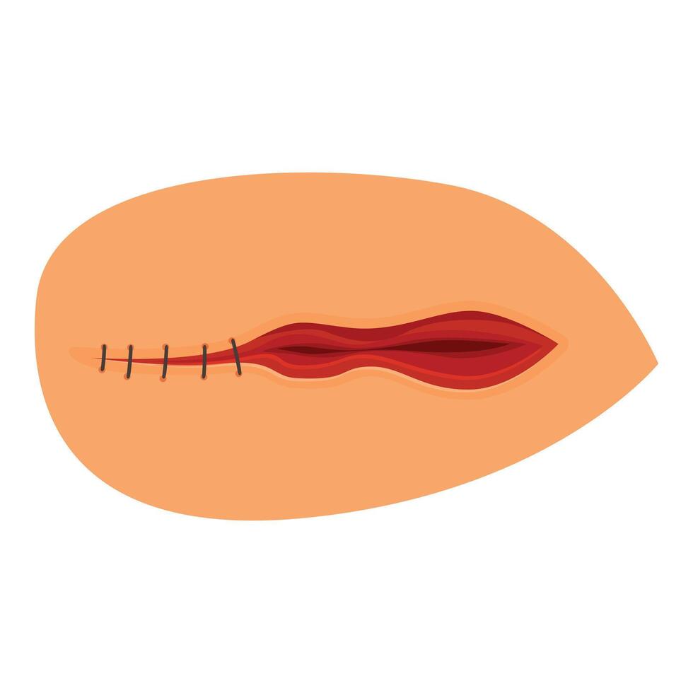 Surgical wound closing with sutures on skin surface vector