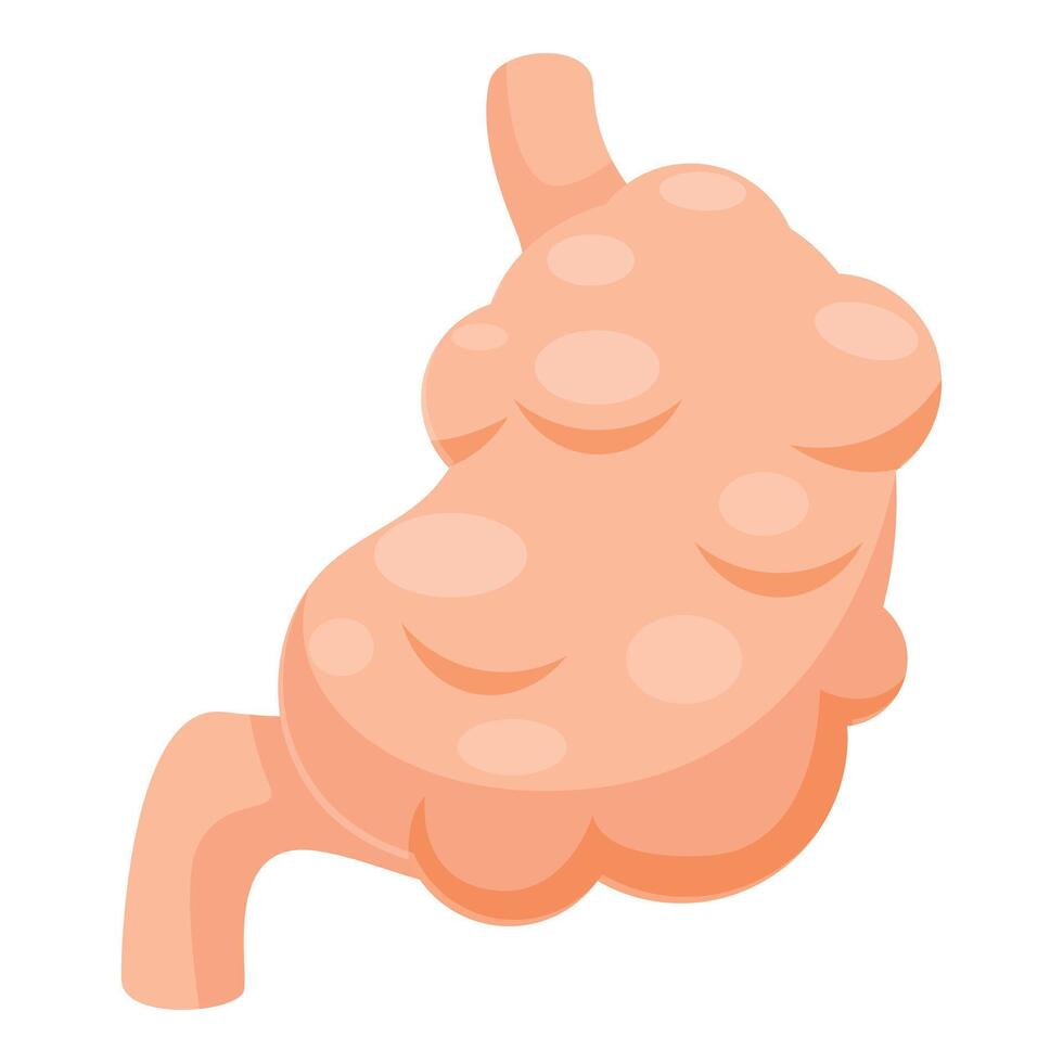 Diseased stomach showing multiple polyps growing inside vector