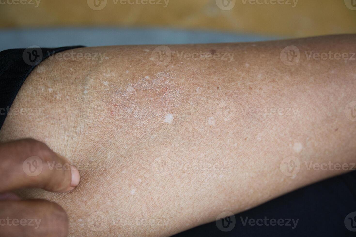 Idiopathic guttate hypomelanosis is a common, harmless skin condition that causes small, flat, white spots on the skin. It's usually found on the arms, legs, and face of older people photo