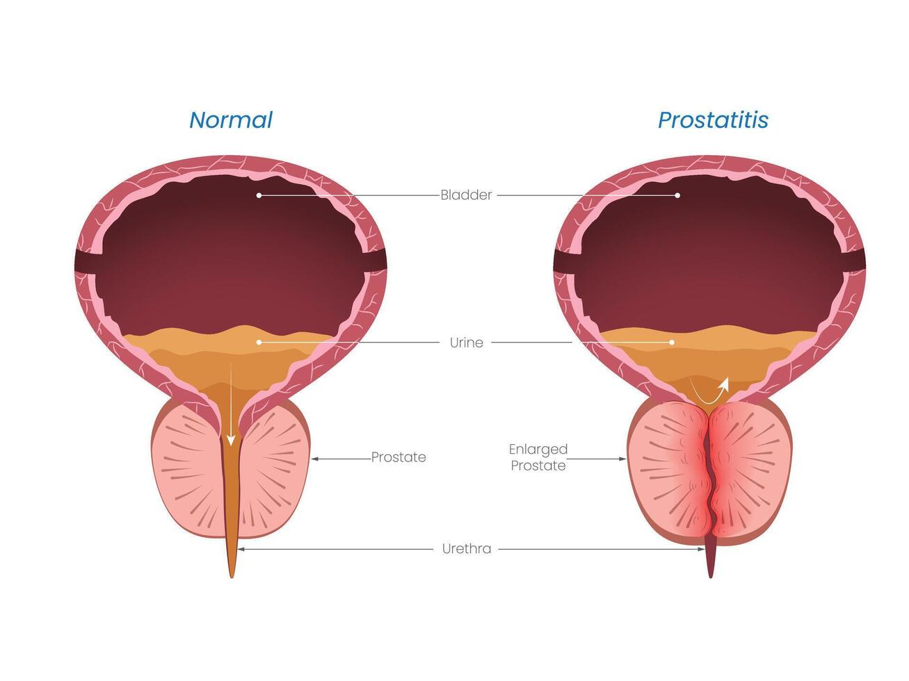 Illustration of Prostatitis Diagram Normal vs Enlarged Prostate vector