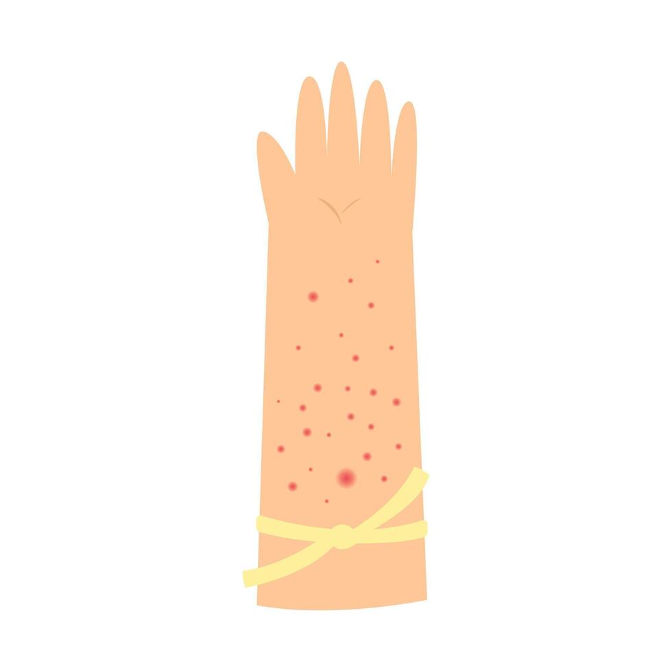 mosquito carrier of dengue fever concept. tourniquet test vector